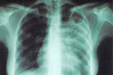 В КВД готовятся диагностировать туберкулез