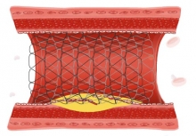 В БСМП усовершенствовали методику операции стентирования на сосудах сердца