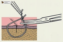 Сколько стоят шовные нити для хирургов КДМЦ?