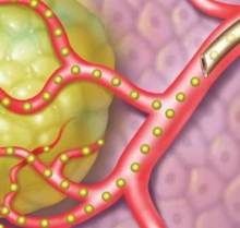 Онкобольному челнинцу продлили жизнь путем химиоэмболизации