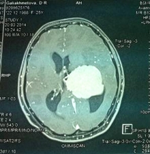 В БСМП впервые провели операцию по удалению опухоли мозга