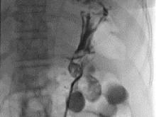 Хирурги БСМП впервые в Татарстане провели пункционную гастростомию с якорной техникой