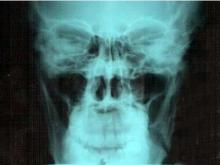 Работник 'КАМАЗа' сломал челюсть в четырех местах