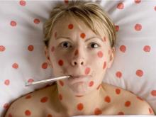 Более 14 тысяч детей в Татарстане заразились ветряной оспой