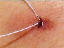 Что делать, если укусил клещ? И куда обращаться за помощью?