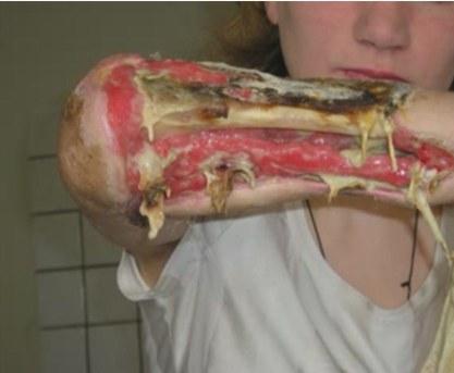 стадия стадия